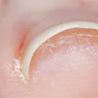 巻き爪